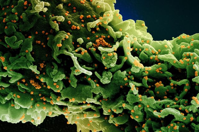 A cell (green) infected with a variant of the SARS-CoV-2 coronavirus (orange), isolated from a patient sample.